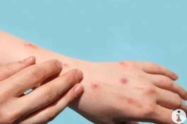 PAFI Kabupaten Purworejo : Beda Gejala Mpox pada Anak, Ruam Paling Banyak Berada di Area Ini